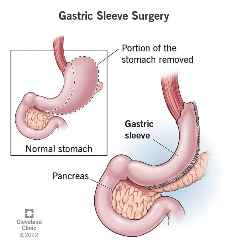 Image of Gastric Sleeve Surgery for weight loss